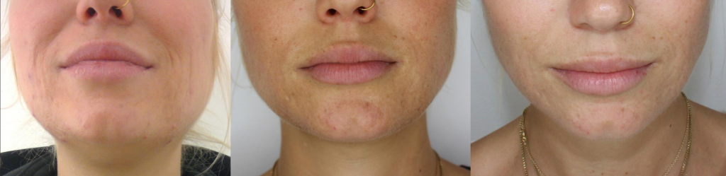 Cryolipolysis, what? The freezing of fat-cells on your body - before & after.